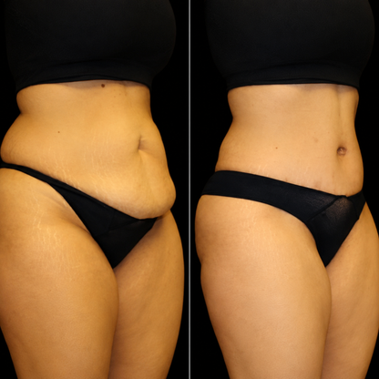 Orvano LumaCore Pro™ Red Light Therapy Belt